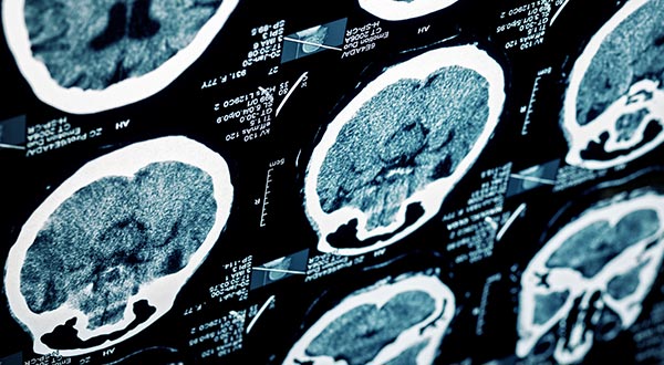 Traumatic Brain Injuries