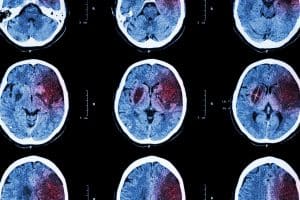 What Is a Secondary Brain Injury? 