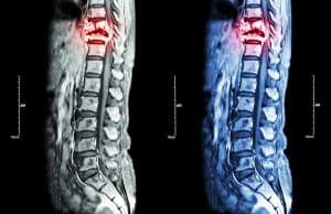 Secondary Complications of Spinal Cord Injuries